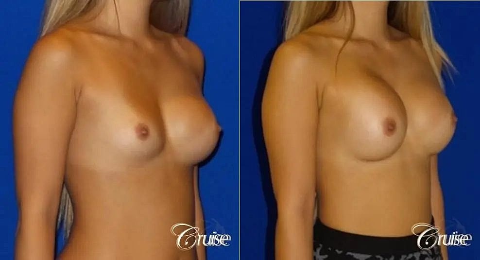 Breast Revision Before & After