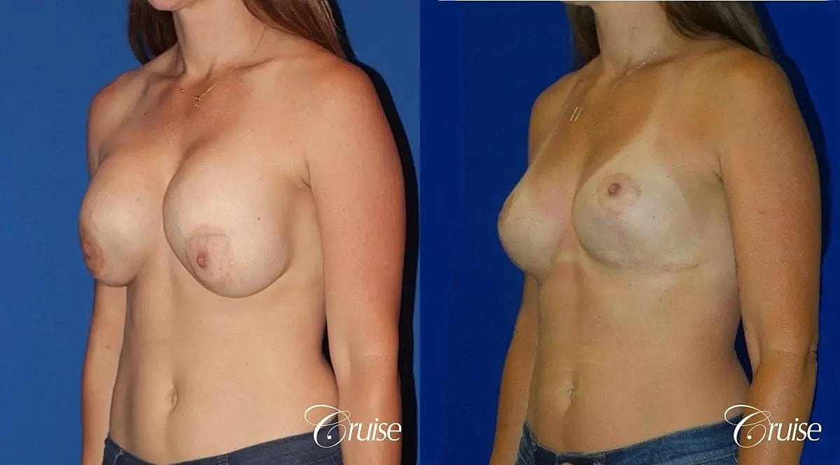 Breast Revision Before & After