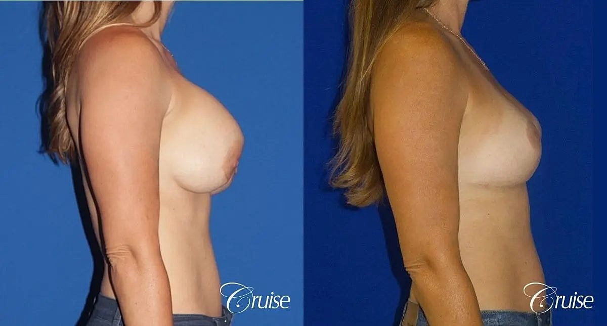 Breast Revision Before & After