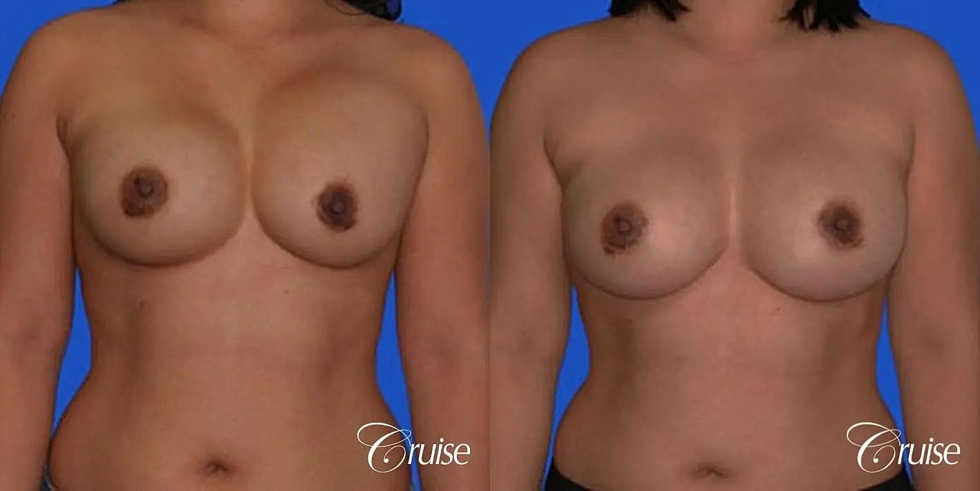 Breast Revision Before & After