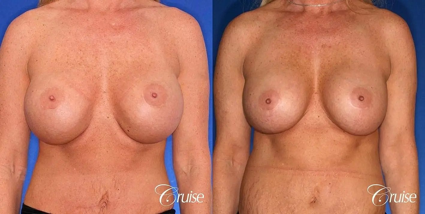 Breast Revision Before & After
