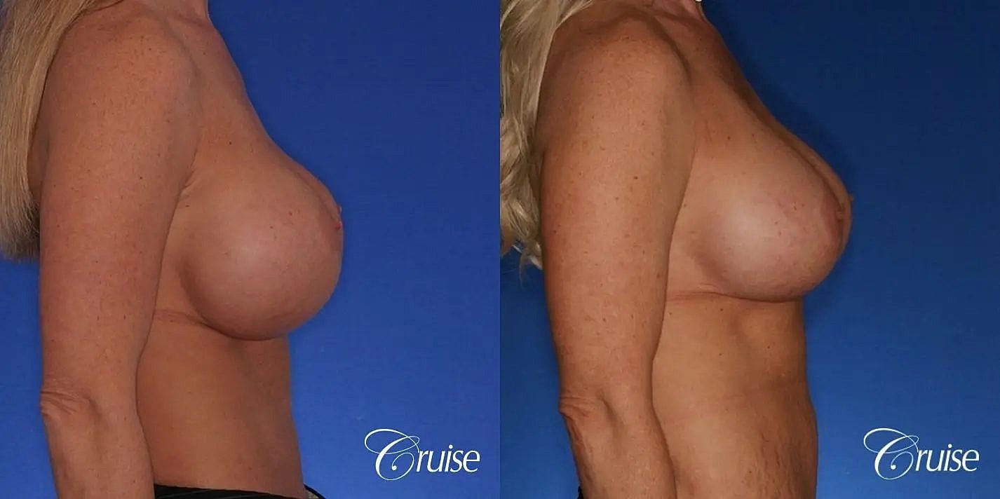 Breast Revision Before & After