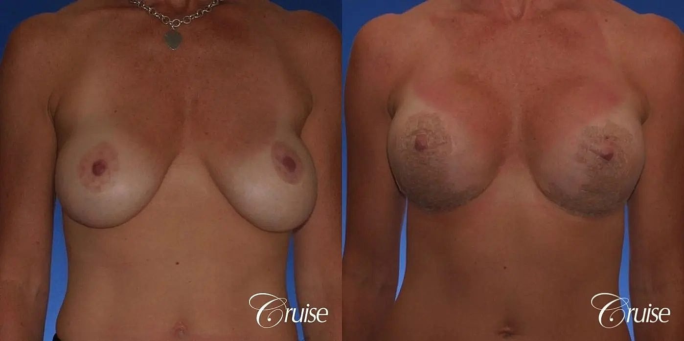 Breast Revision Before & After