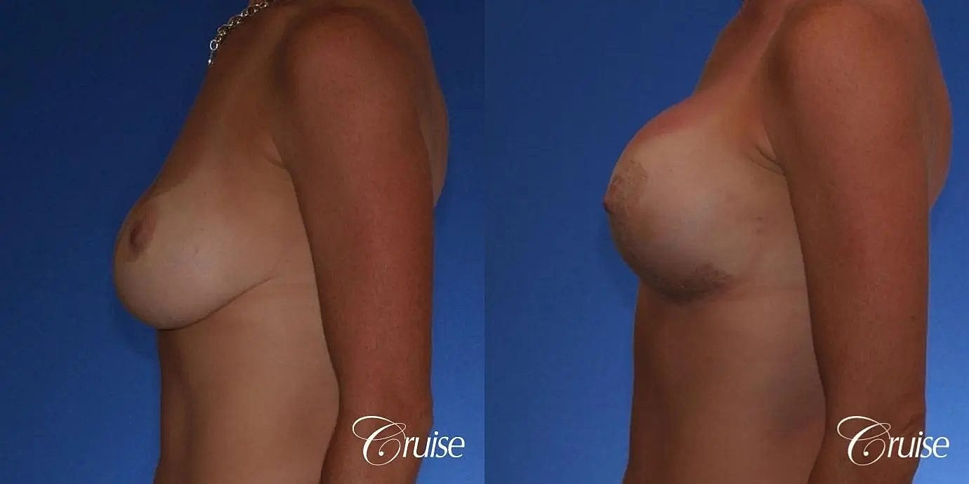 Breast Revision Before & After
