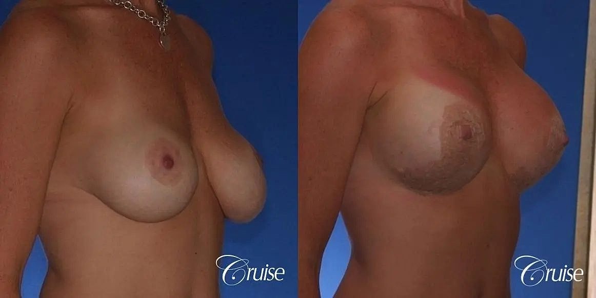 Breast Revision Before & After