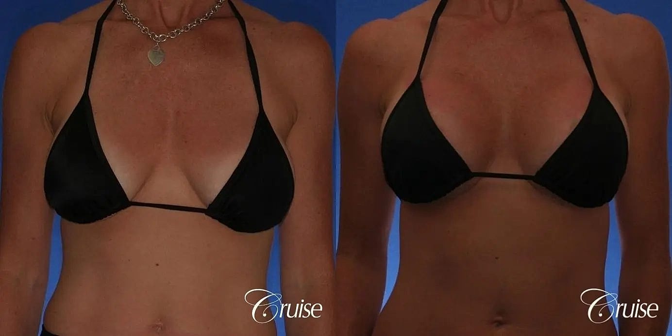 Breast Revision Before & After