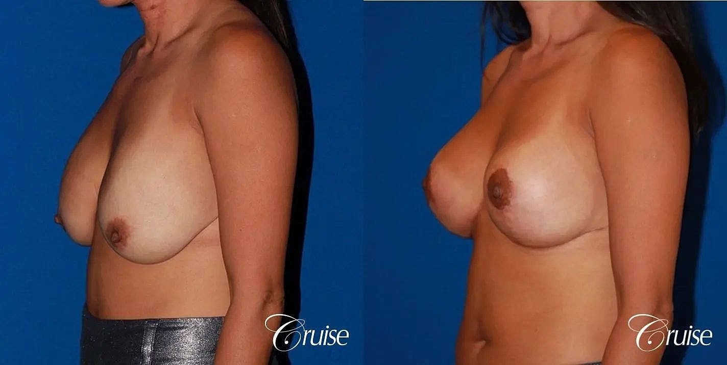 Breast Revision Before & After