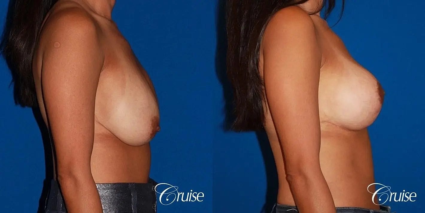 Breast Revision Before & After