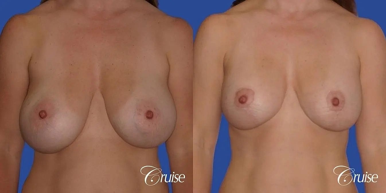 Breast Revision Before & After