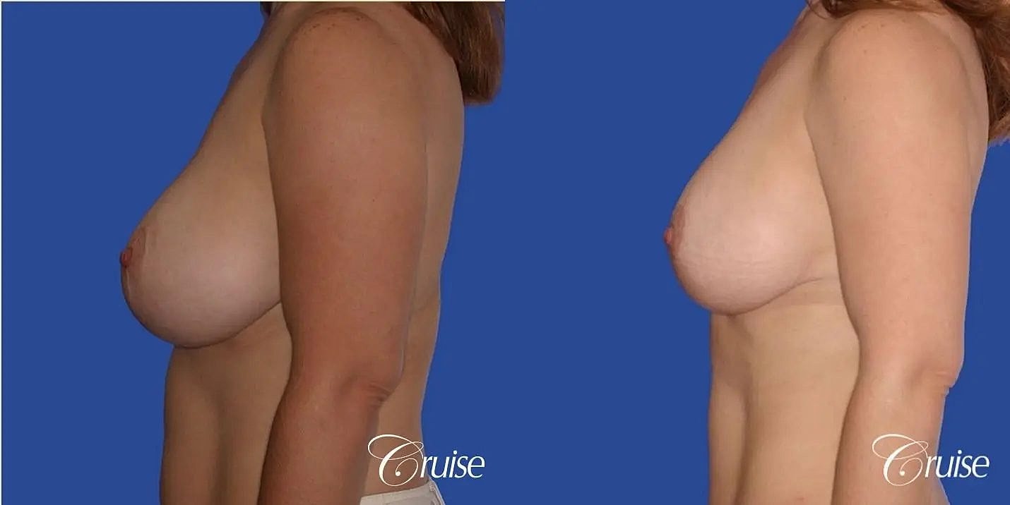 Breast Revision Before & After
