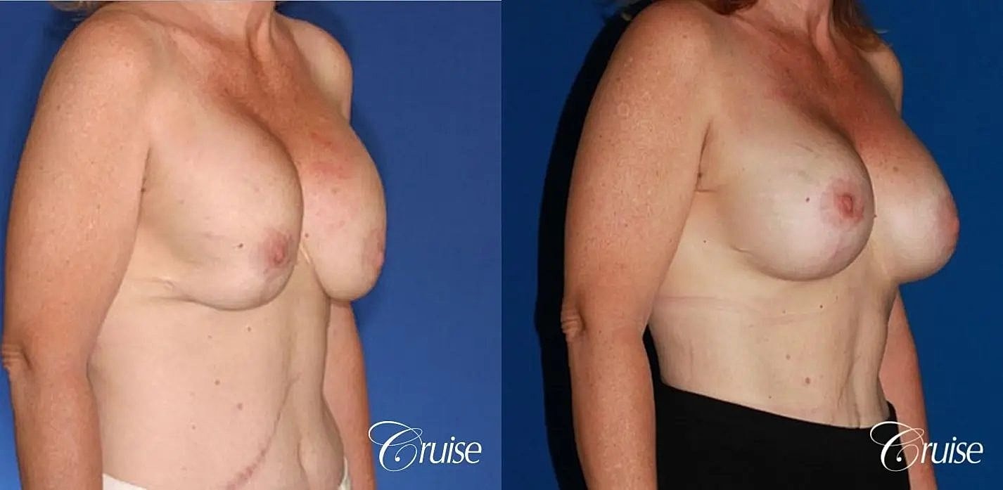 Breast Revision Before & After
