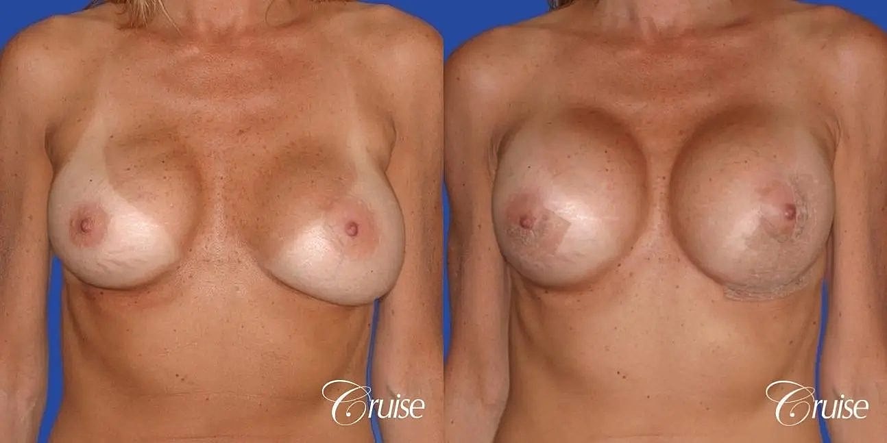 Breast Revision Before & After