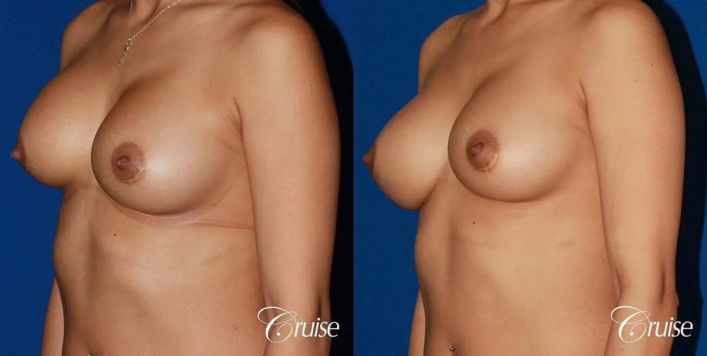 Breast Revision Before & After