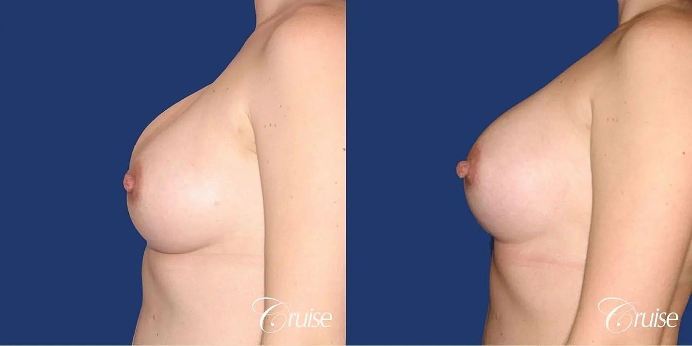 Breast Revision Before & After