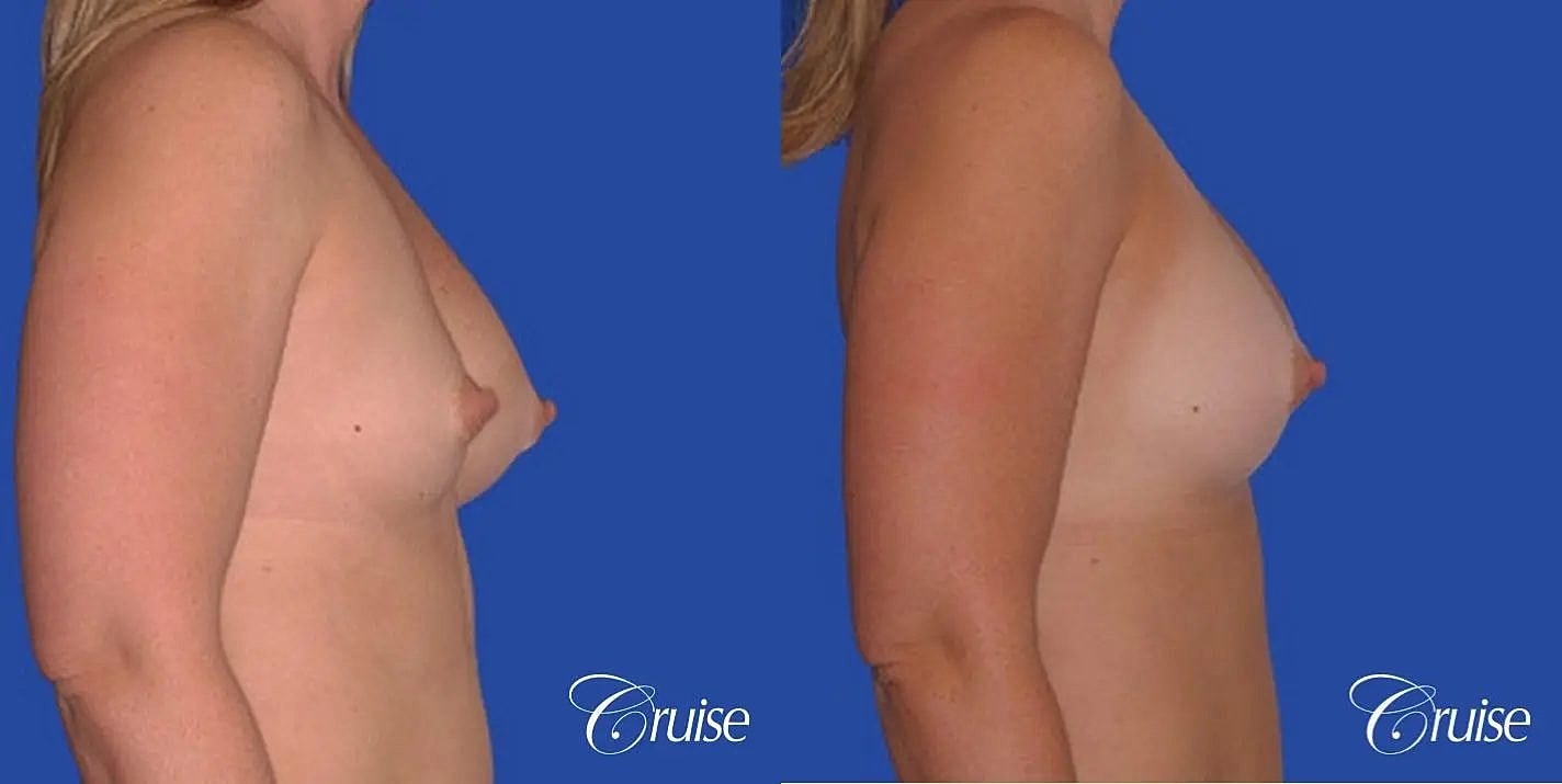 Breast Revision Before & After