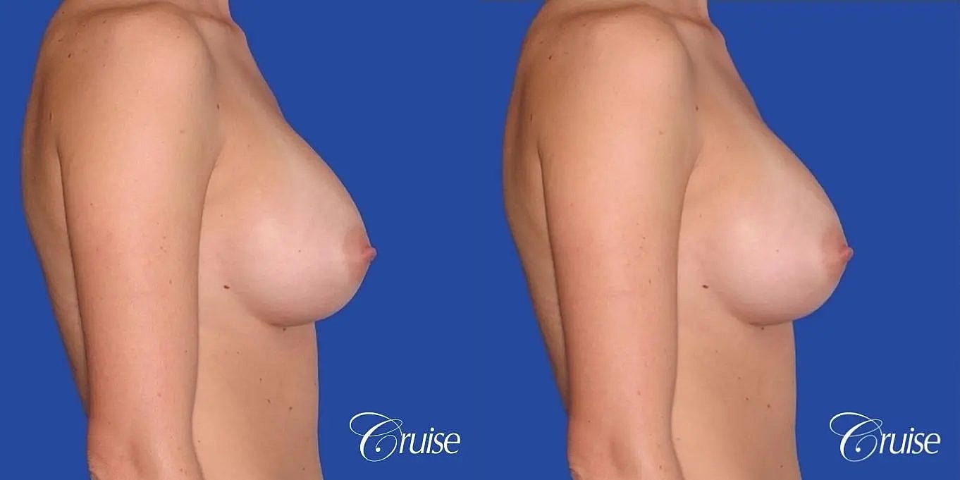 Breast Revision Before & After