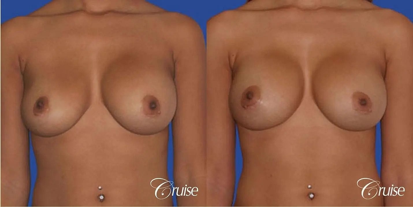 Breast Revision Before & After