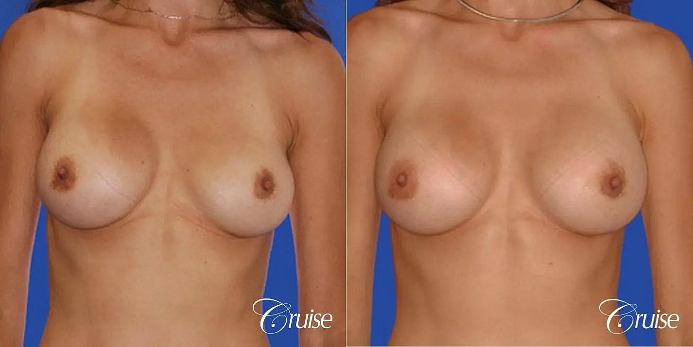 Breast Revision Before & After