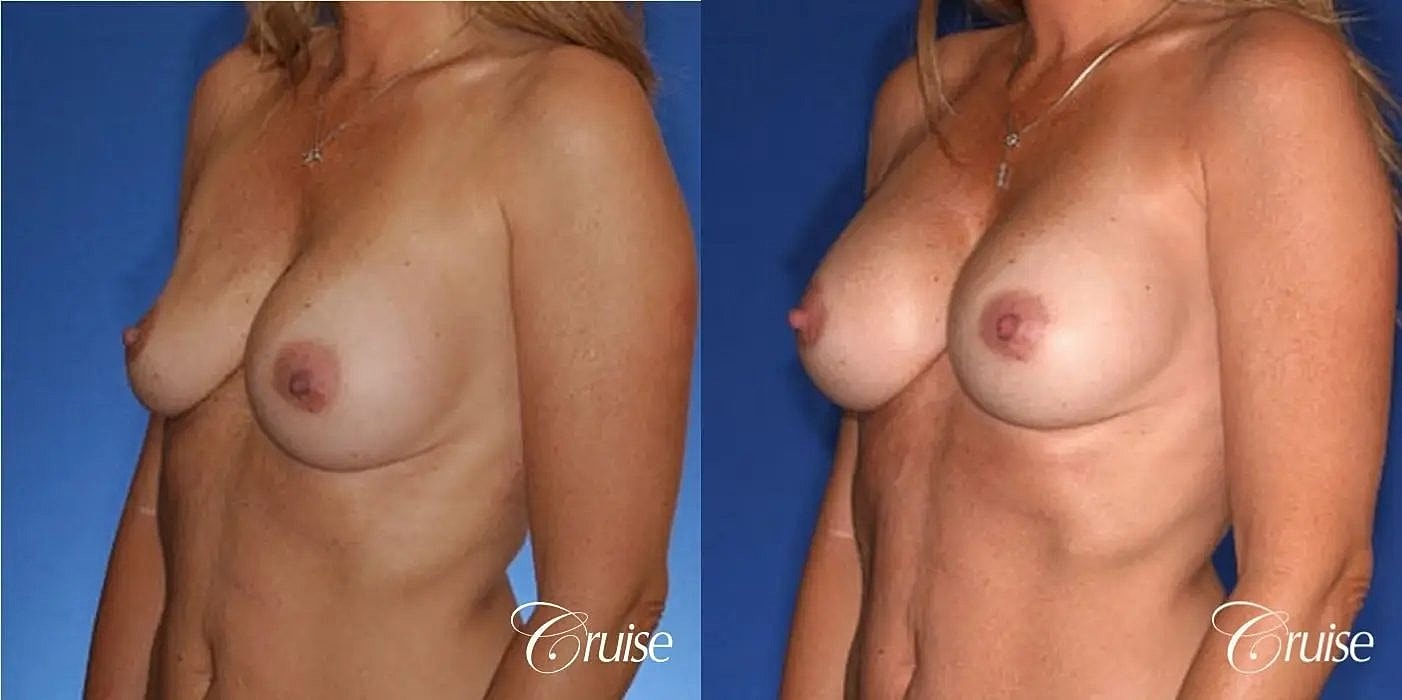 Breast Revision Before & After