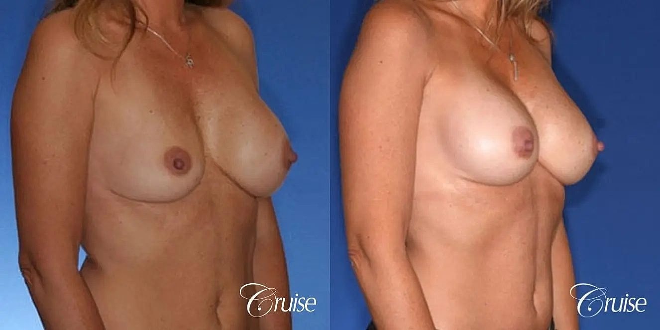 Breast Revision Before & After