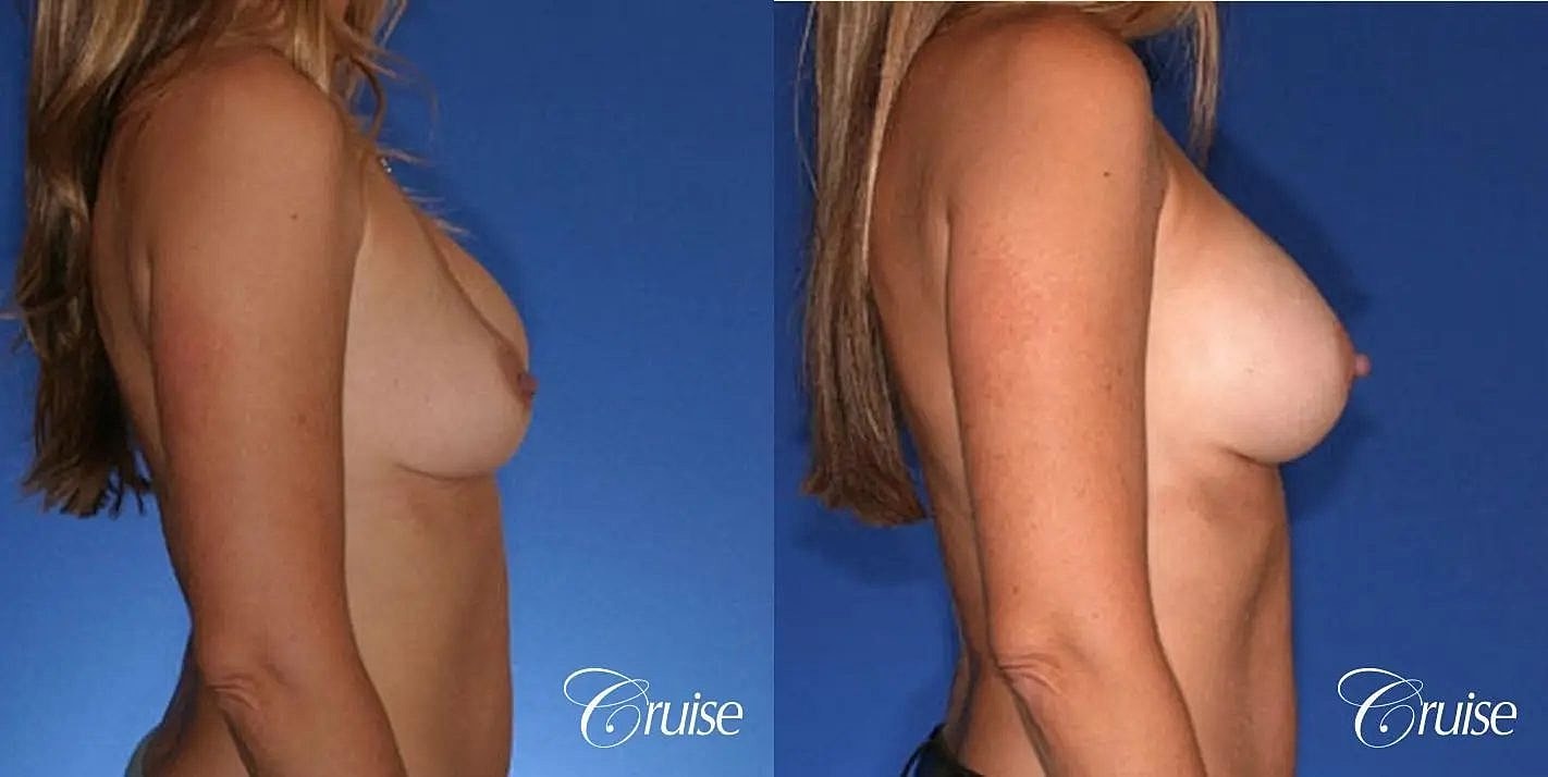 Breast Revision Before & After