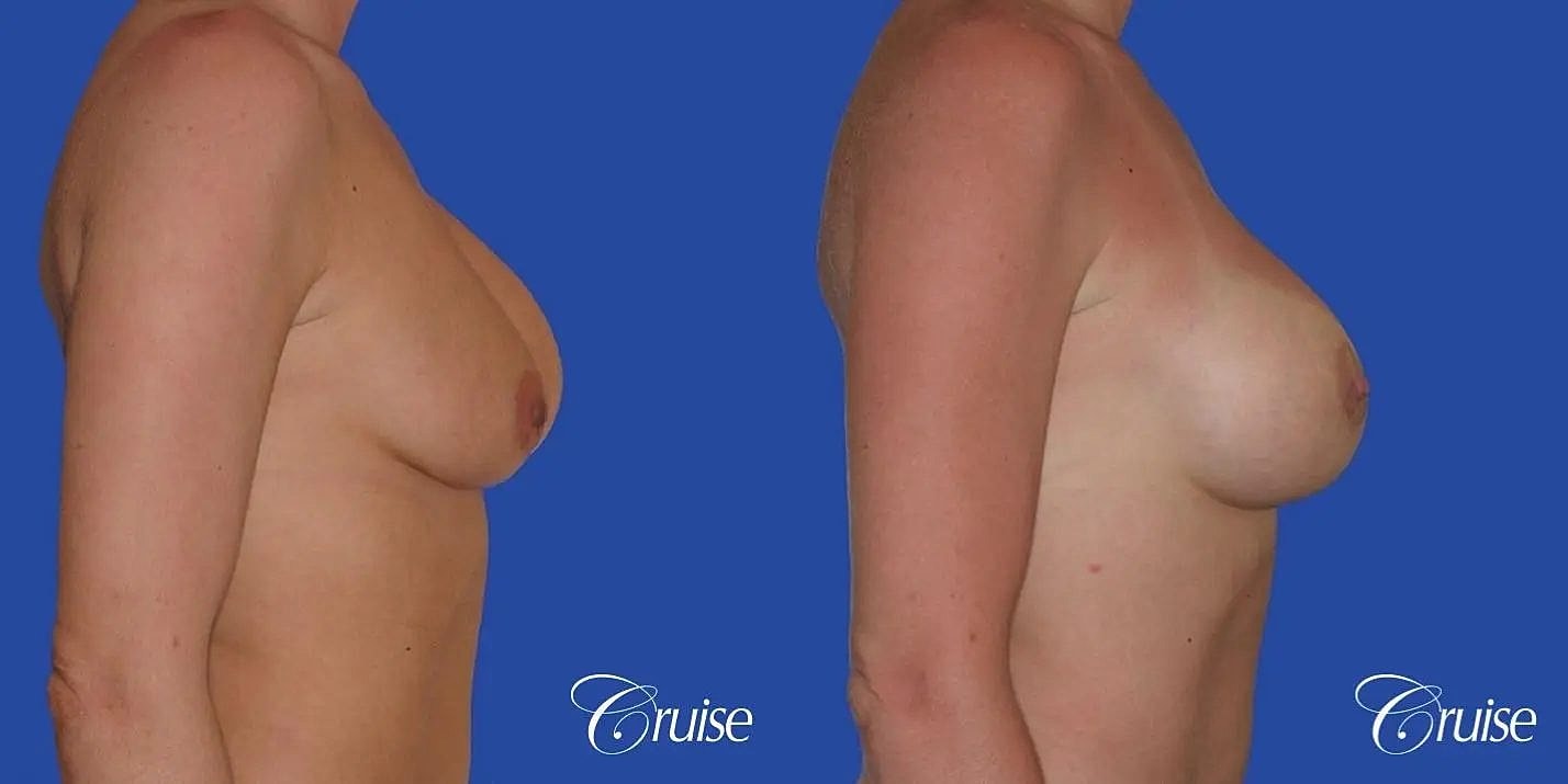 Breast Revision Before & After
