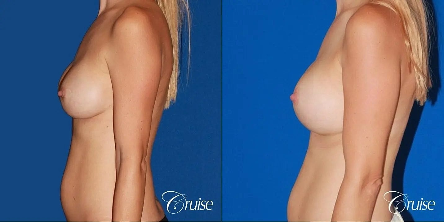 Breast Revision Before & After