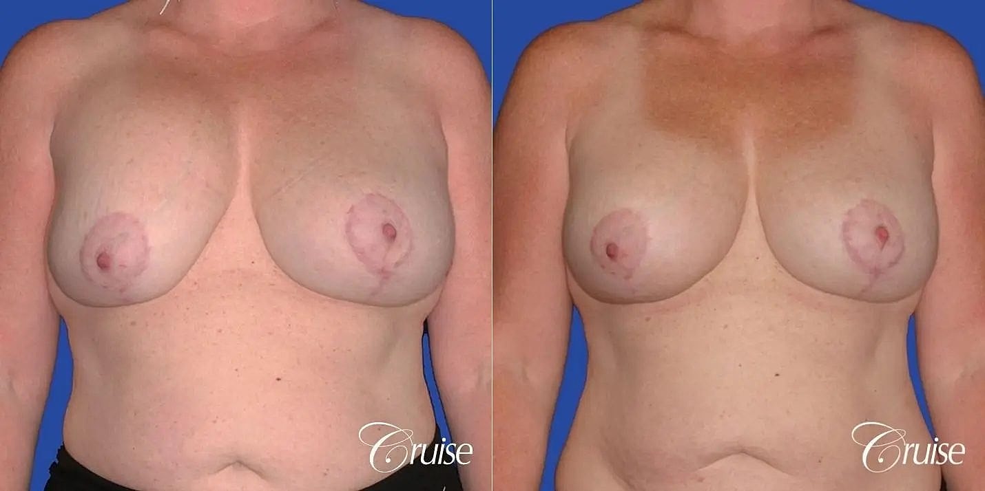 Breast Revision Before & After
