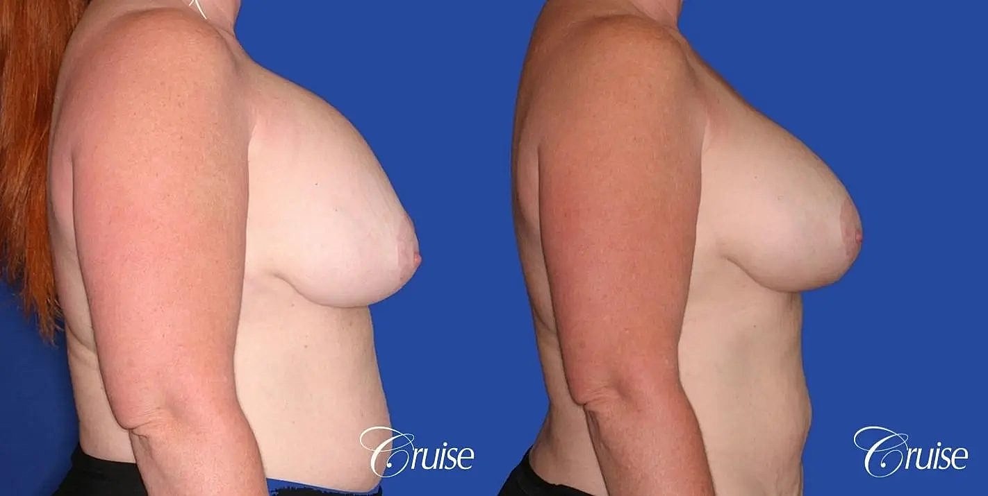 Breast Revision Before & After