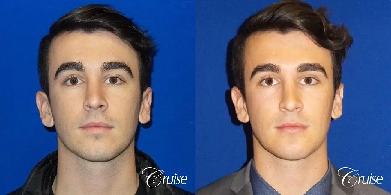 Chin Augmentation Before & After