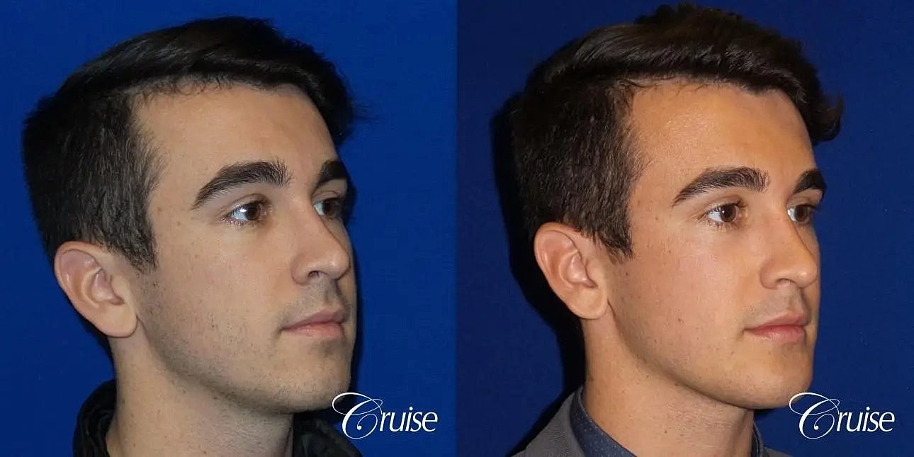 Chin Augmentation Before & After