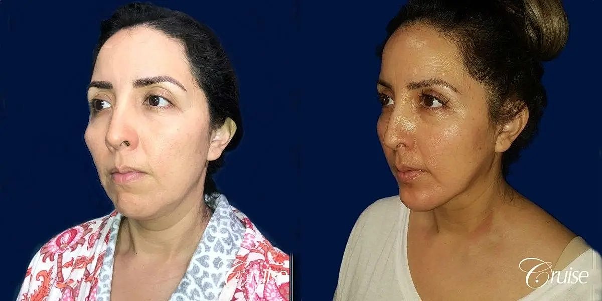 Chin Augmentation Before & After