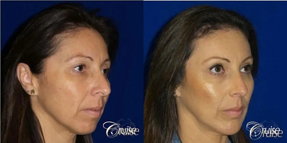 Chin Augmentation Before & After