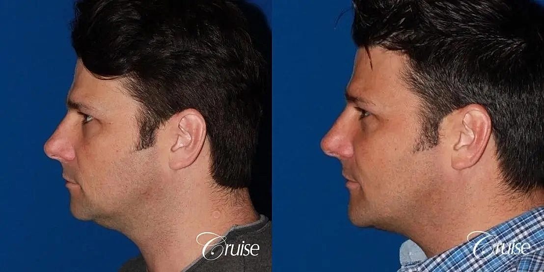 Chin Augmentation Before & After