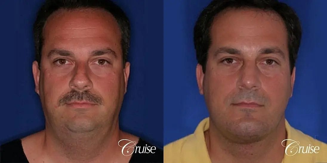 Chin Augmentation Before & After