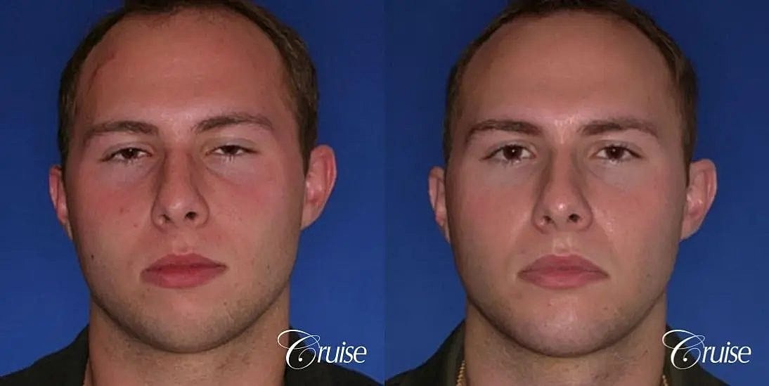 Chin Augmentation Before & After