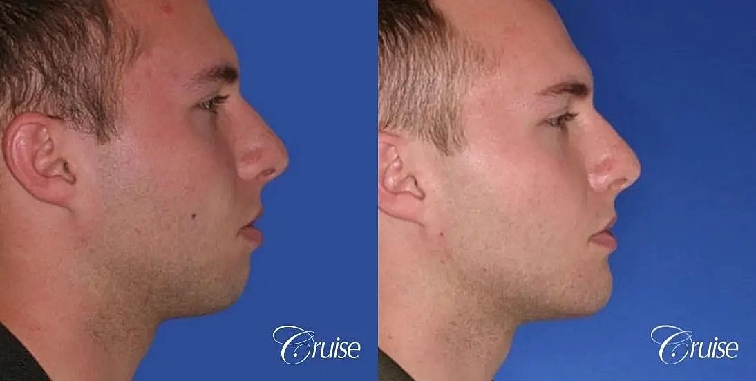 Chin Augmentation Before & After