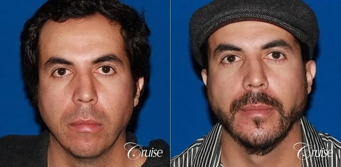 Chin Augmentation Before & After