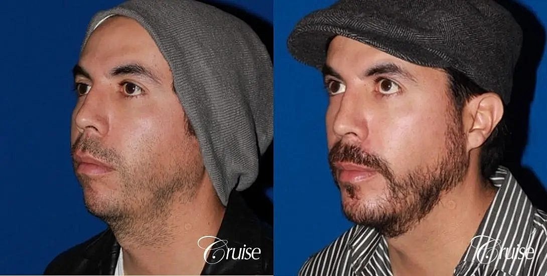 Chin Augmentation Before & After