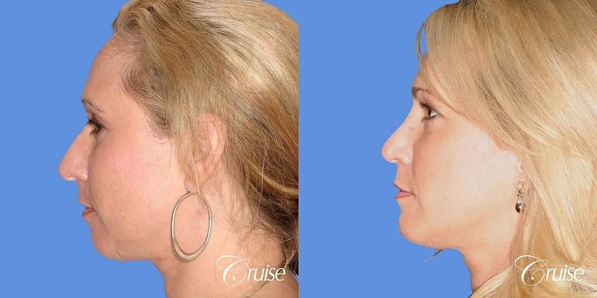 Chin Augmentation Before & After