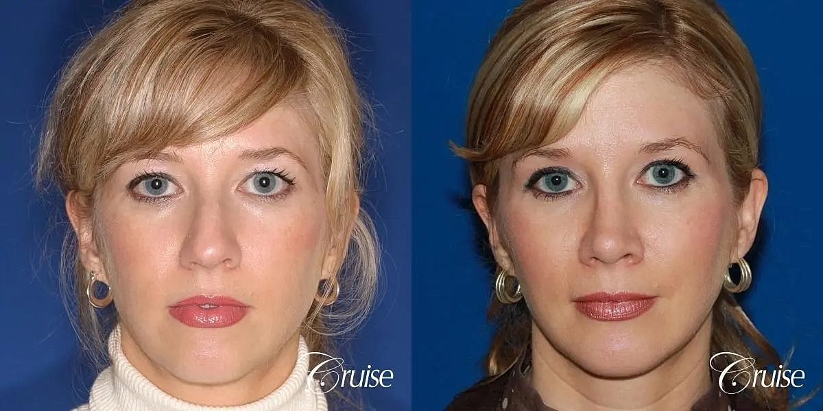 Chin Augmentation Before & After