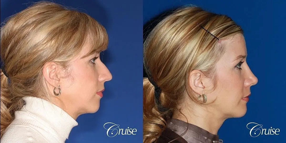 Chin Augmentation Before & After