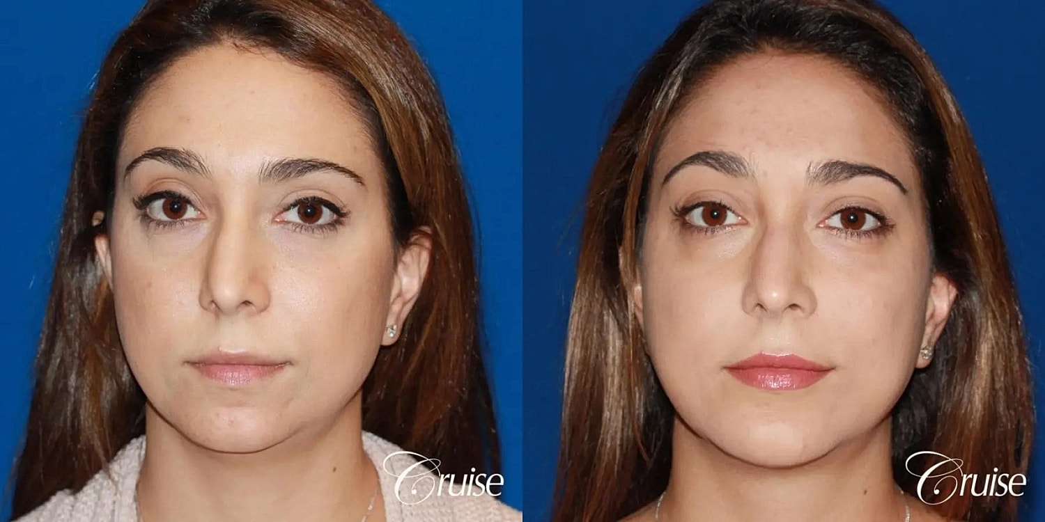 Chin Augmentation Before & After