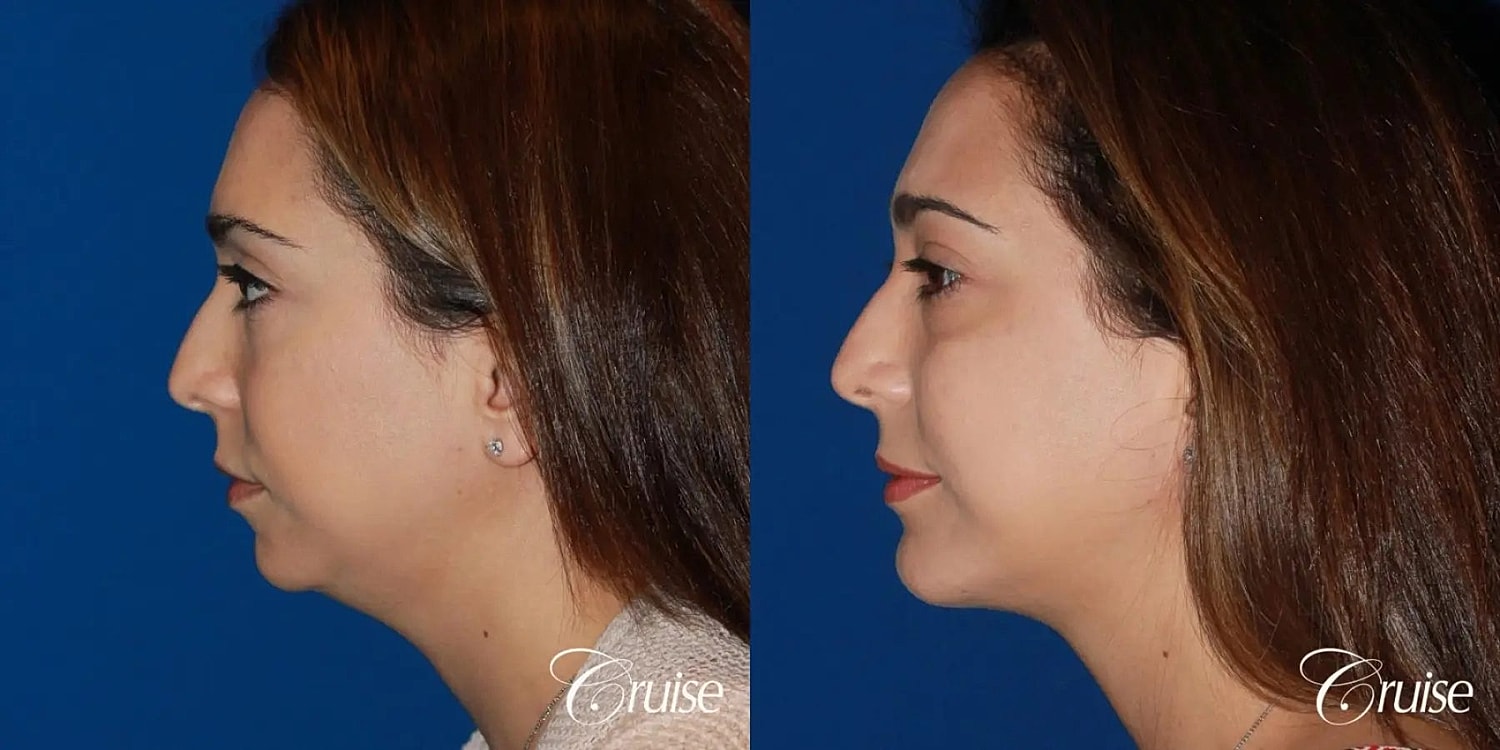 Chin Augmentation Before & After