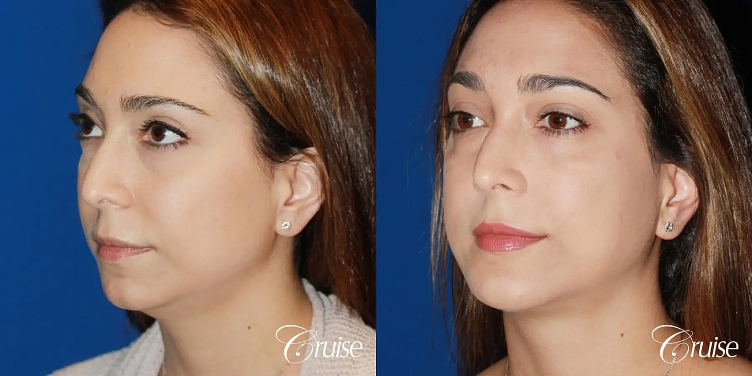 Chin Augmentation Before & After