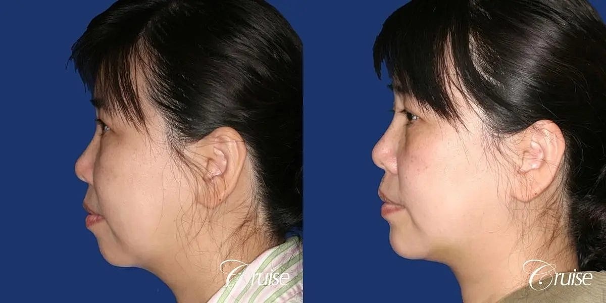 Chin Augmentation Before & After