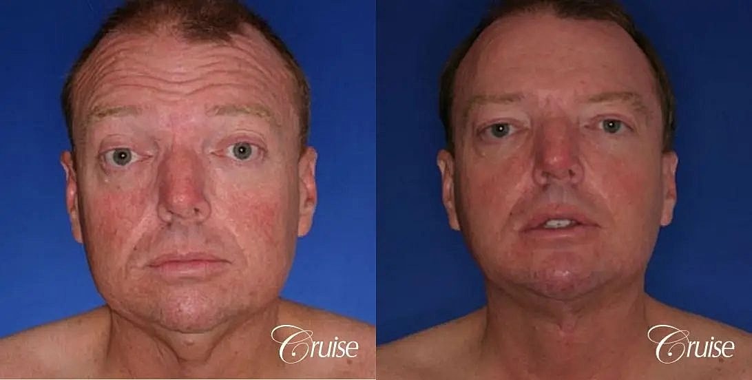 Chin Augmentation Before & After