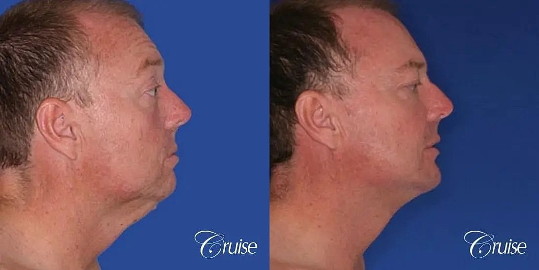 Chin Augmentation Before & After