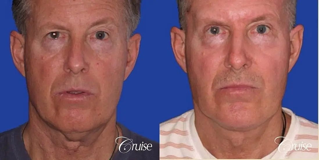 Chin Augmentation Before & After