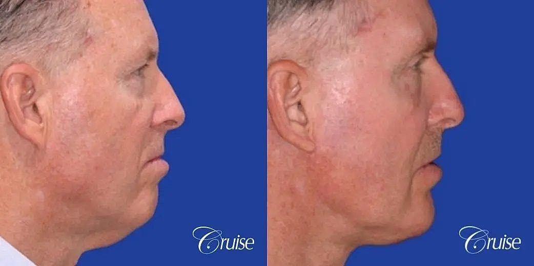 Chin Augmentation Before & After